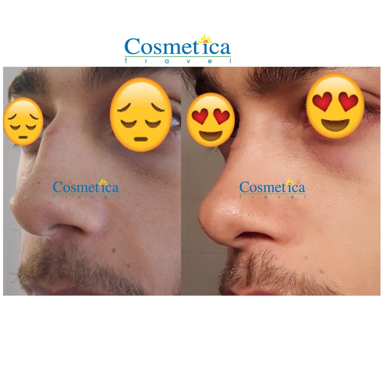 rhinoplastie homme avant apres